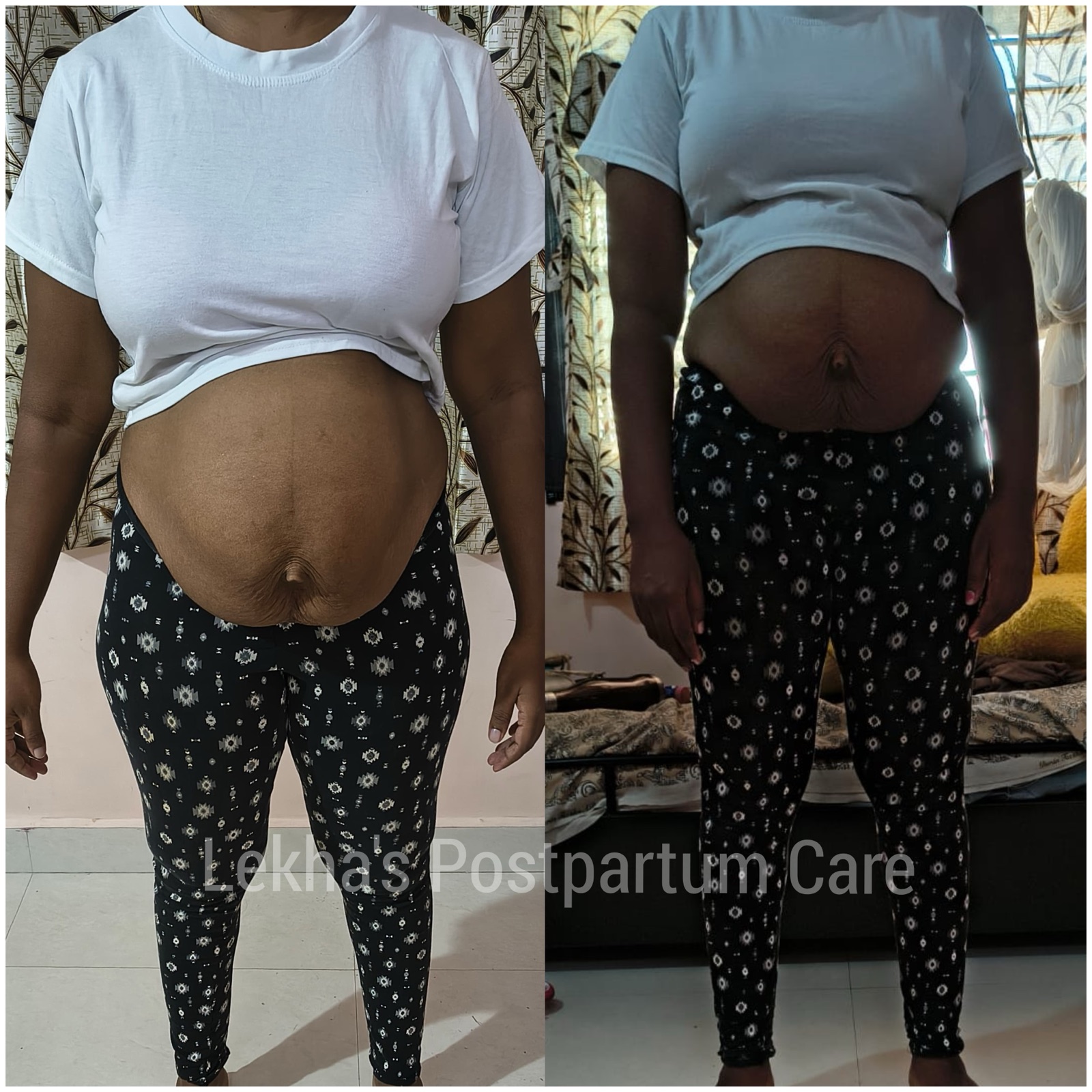 Core recovery progress after postpartum physiotherapy